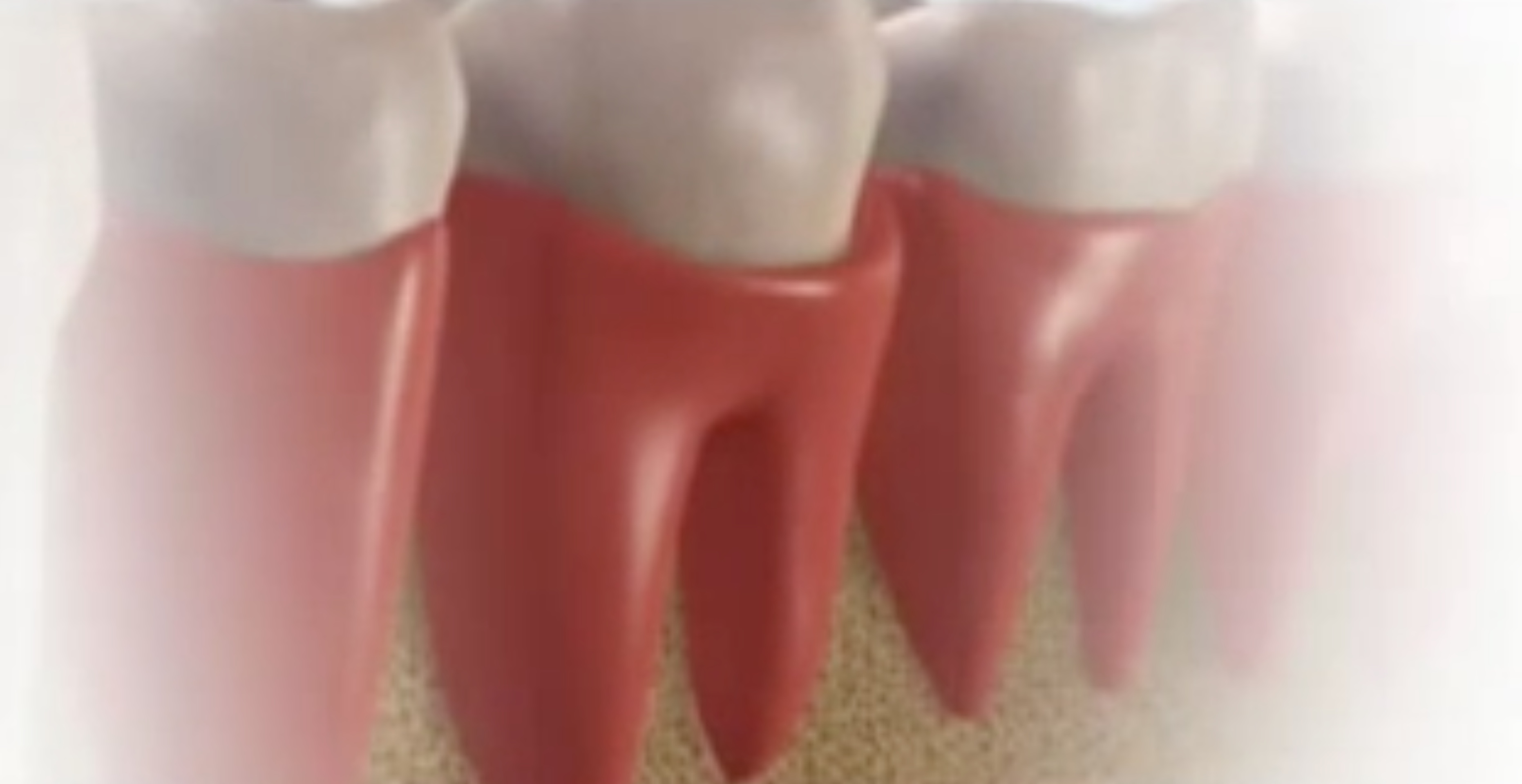 Parodontose Zahnarztpraxis Roger Barz Zahngesundheit Halle