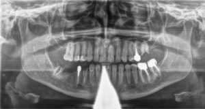 Zahnarzt-Roger-Barz-Halle-Zahngesundheit-OPG