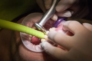 Behandlung Zahnarzt Zahngesundheit Halle