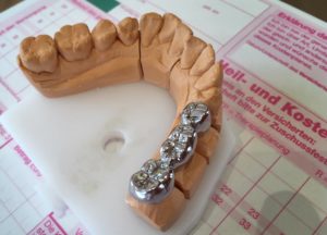 Metallbrücke Zahnarztpraxis Roger Barz Halle